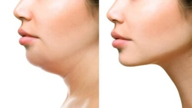 Double Chin Removal in Dubai