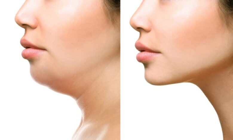 Double Chin Removal in Dubai